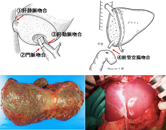 摘出された肝臓 移植された肝臓