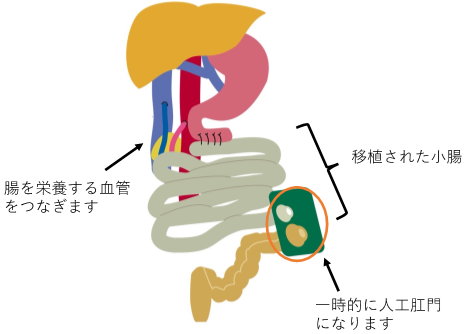 小腸移植の模式図