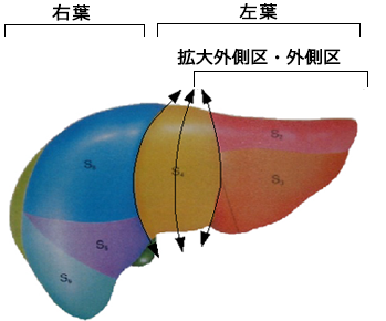 グラフト採取術における肝臓の切離ラインを示した図。左の図に、体格の小さな乳児で選択される外側区域が赤で示されている